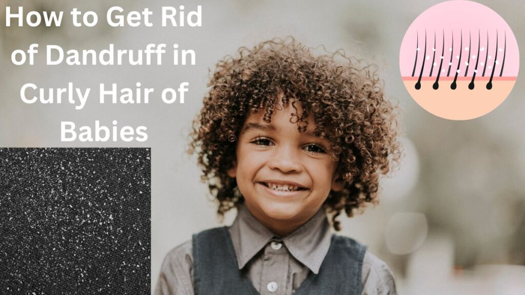 how to get rid of dandruff in curly hair